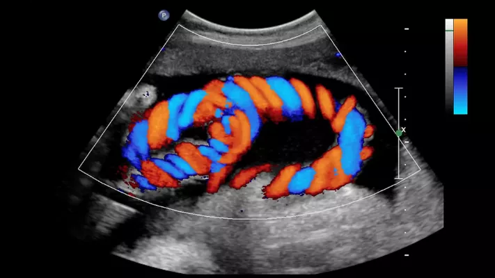 color-doppler-69abed1c0529b